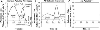 Subject-specific factors affecting particle residence time distribution of left atrial appendage in atrial fibrillation: A computational model-based study